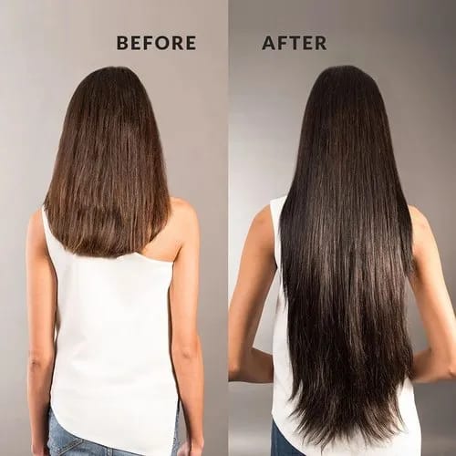 Before After Hair Transplant