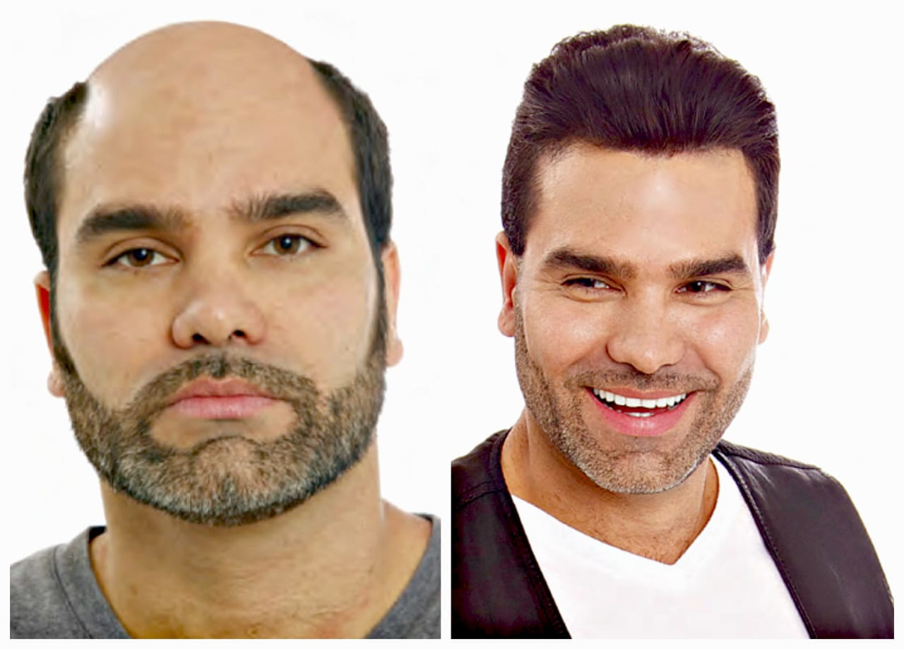 Another Before After Hair Transplant
