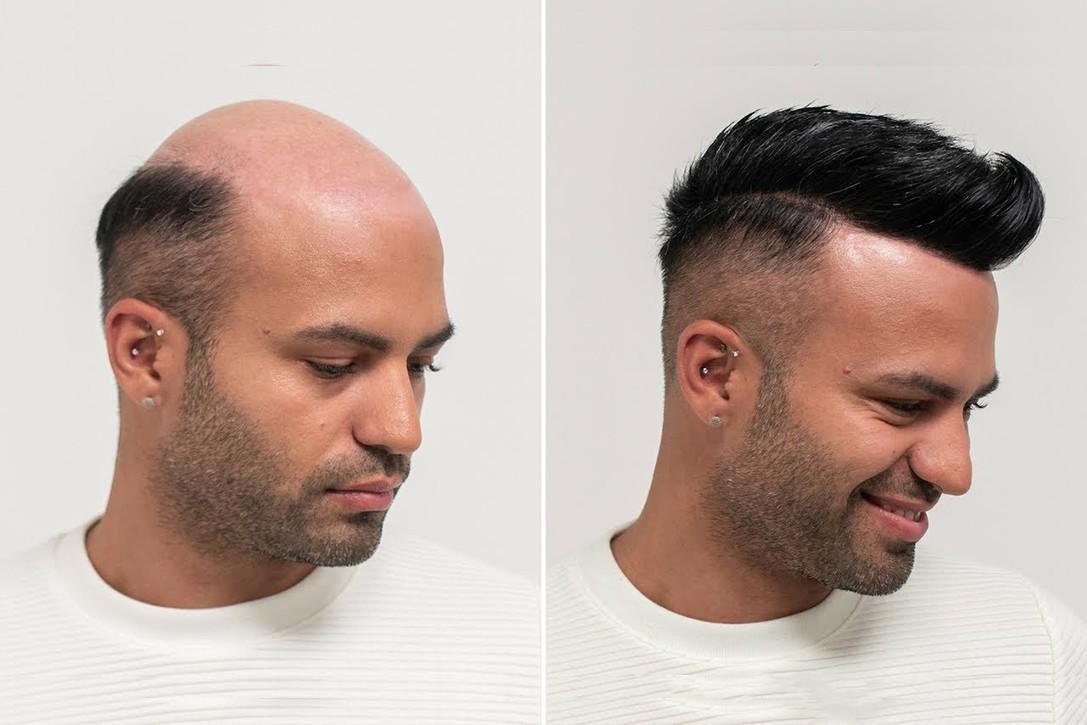 Hair Transplant