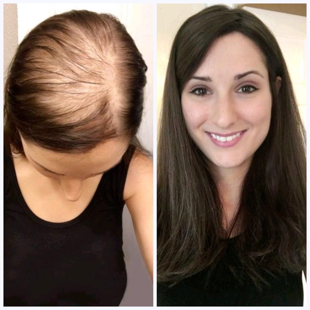 Another Before After Hair Transplant